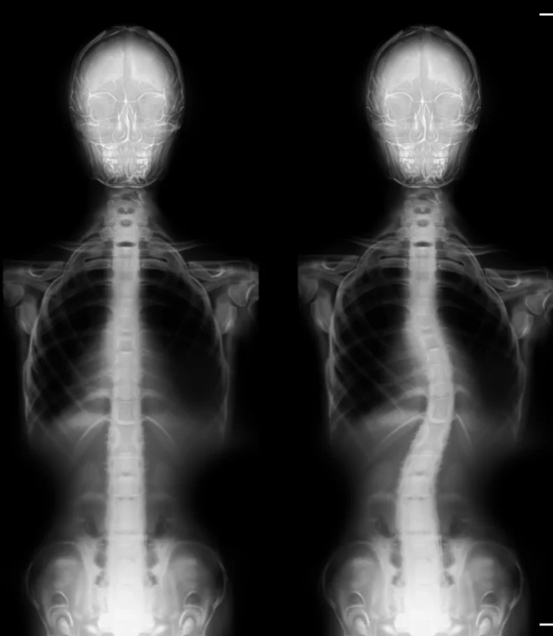 Scoliosis Elkhorn